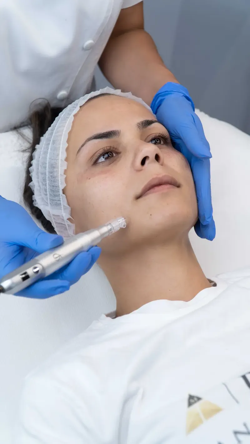 Microneedling-behandling hos LymphCore Longevity Stockholm