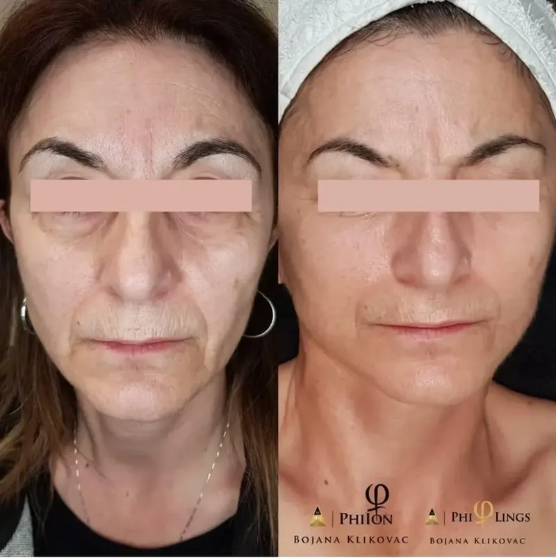 Före och efter microneedling – slätare hud och reducerade linjer i ansiktet